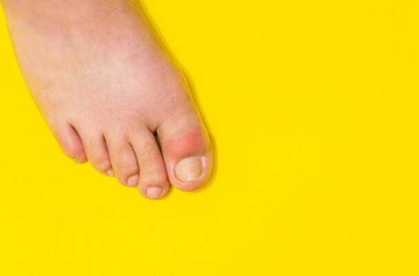 goutte-pieds